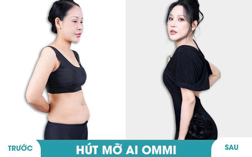Ảnh khách hàng thẩm mỹ mũi tại JK Nhật Hàn 13