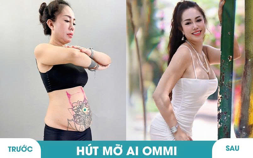 Ảnh khách hàng thẩm mỹ mũi tại JK Nhật Hàn 14