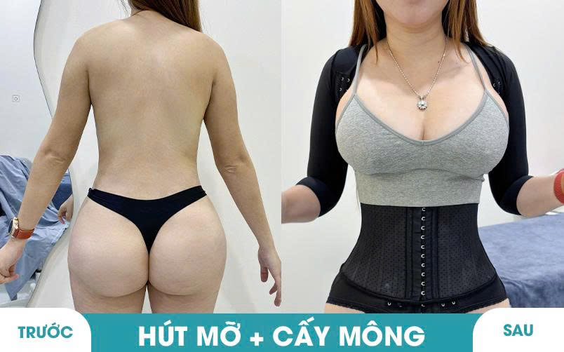 Ảnh khách hàng thẩm mỹ mũi tại JK Nhật Hàn 15