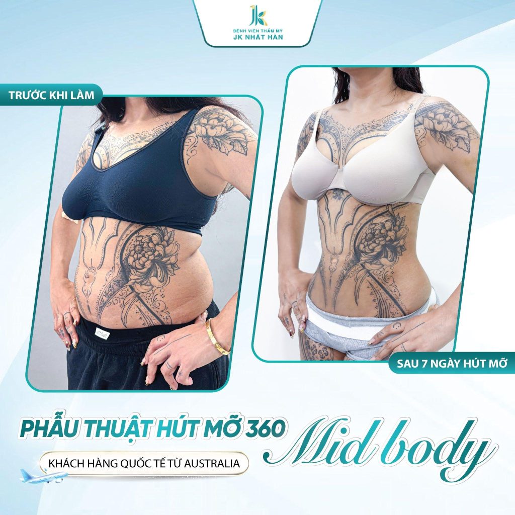 hút mỡ AI Ommi