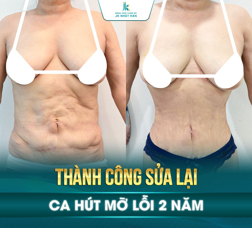 xử lý biến chứng hút mỡ