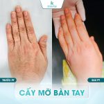 cấy mỡ bàn tay