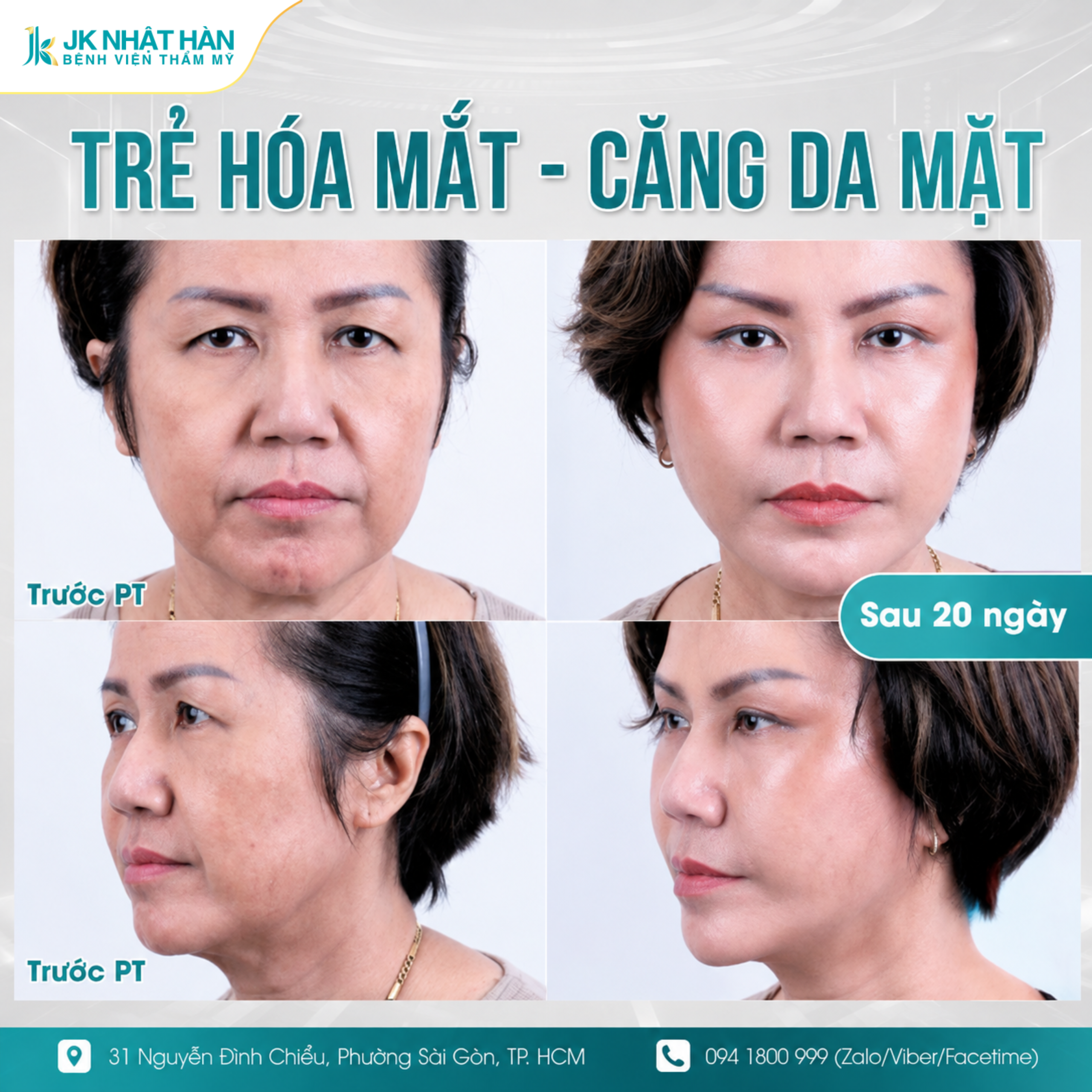 Những ưu điểm được quan tâm khi thực hiện căng da mặt Deep Plane