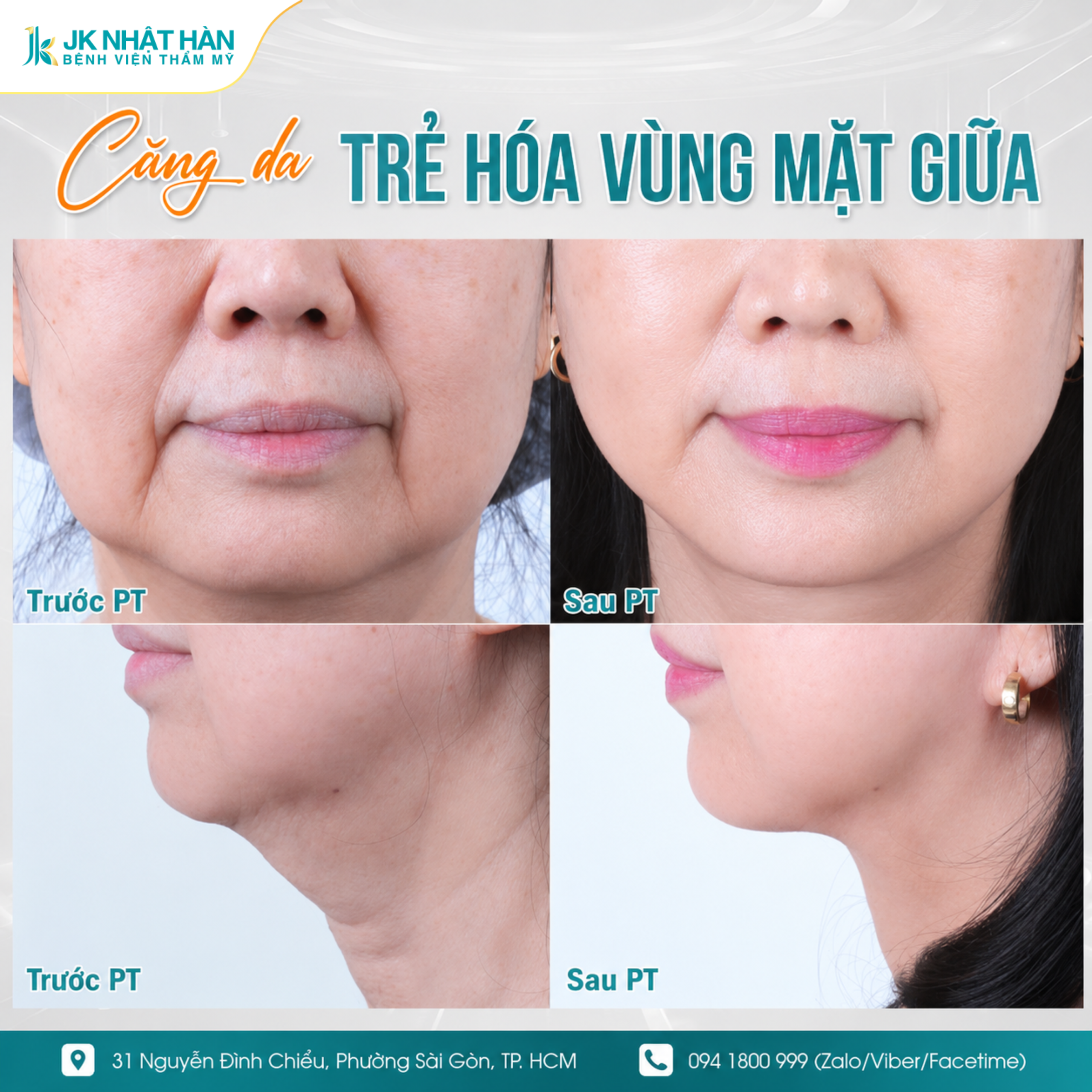 Điểm khác biệt cốt lõi của Deep Plane: Không chỉ kéo da