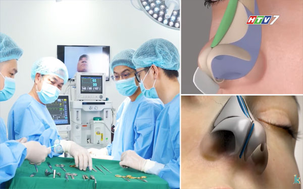 Giải pháp xử lý thẩm mỹ mũi khó htv7