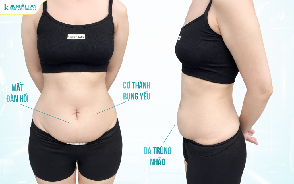 Ai phù hợp với tạo hình thành bụng mini?