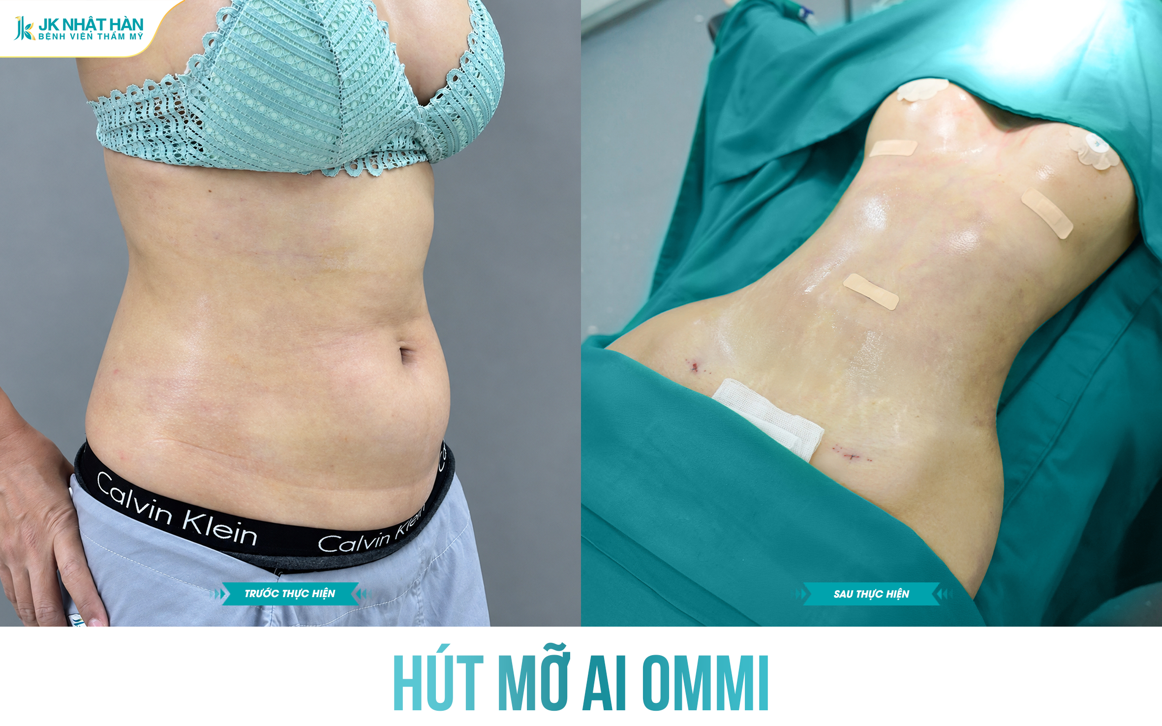 Công nghệ hút mỡ AI OMMI tại JK Nhật Hàn – Giải pháp siết eo chuẩn tỷ lệ vàng, rút ngắn thời gian đeo gen bụng